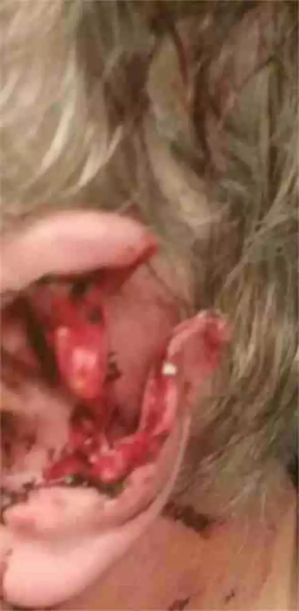 Unbelievable: Man Wakes Up With Half of His Ear Totally Ripped Off... And Has No Clue What Happened